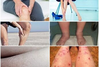 Síntomas de las venas varicosas en las piernas
