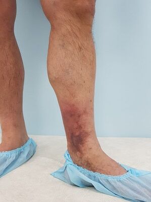 complicaciones de las venas varicosas en los hombres