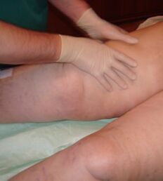 Masaje terapéutico en la parte inferior de la pierna con varices