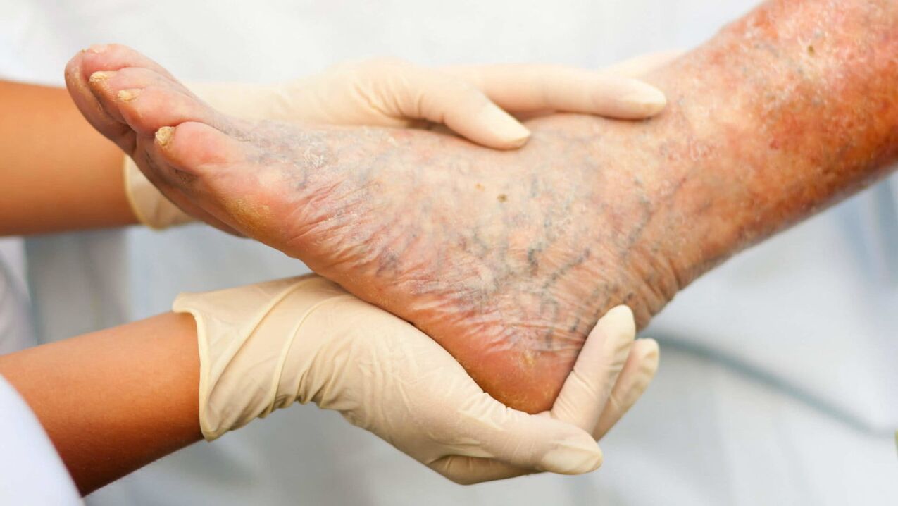 Los flebólogos se ocupan del tratamiento de las venas varicosas en las piernas. 