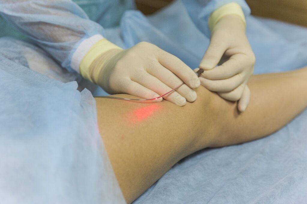 Tratamiento con láser de venas varicosas en la parte inferior de la pierna. 