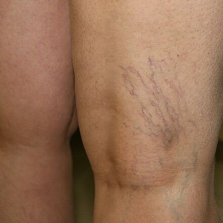 La malla venosa en la parte inferior de la pierna es un signo de venas varicosas