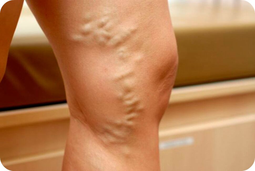 Varices