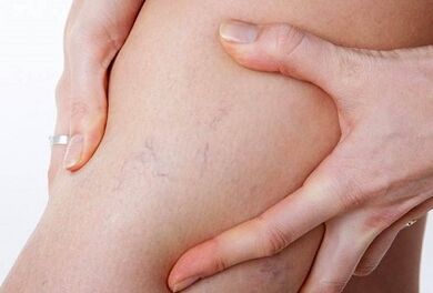Acciones prohibidas para las venas varicosas