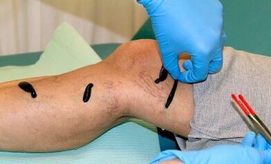 Hirudoterapia para venas varicosas