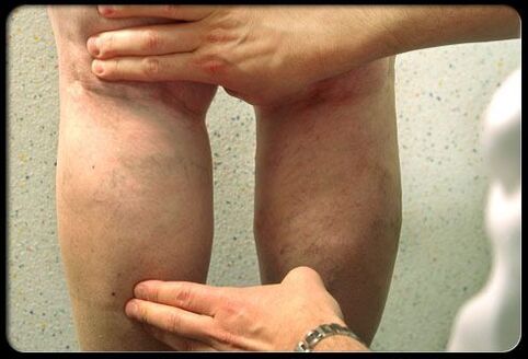 El médico examina los pies con venas varicosas