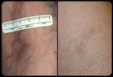 Procedimiento de terapia con láser antes y después
