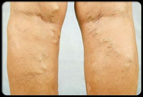 Venas varicosas en los pies